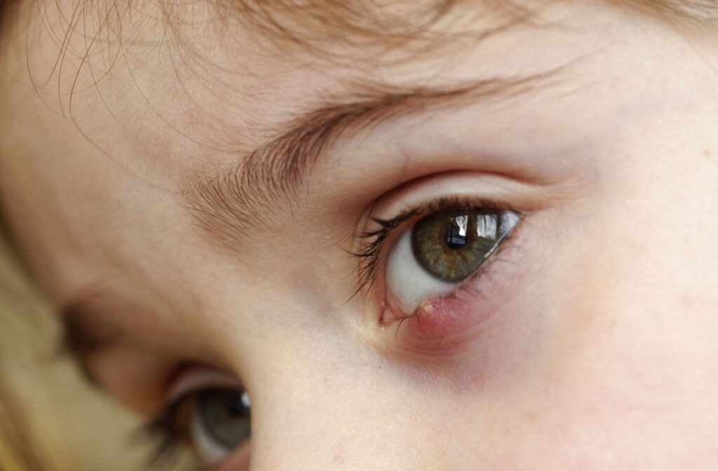 A close up of a childs eye that is experiencing an eye stye